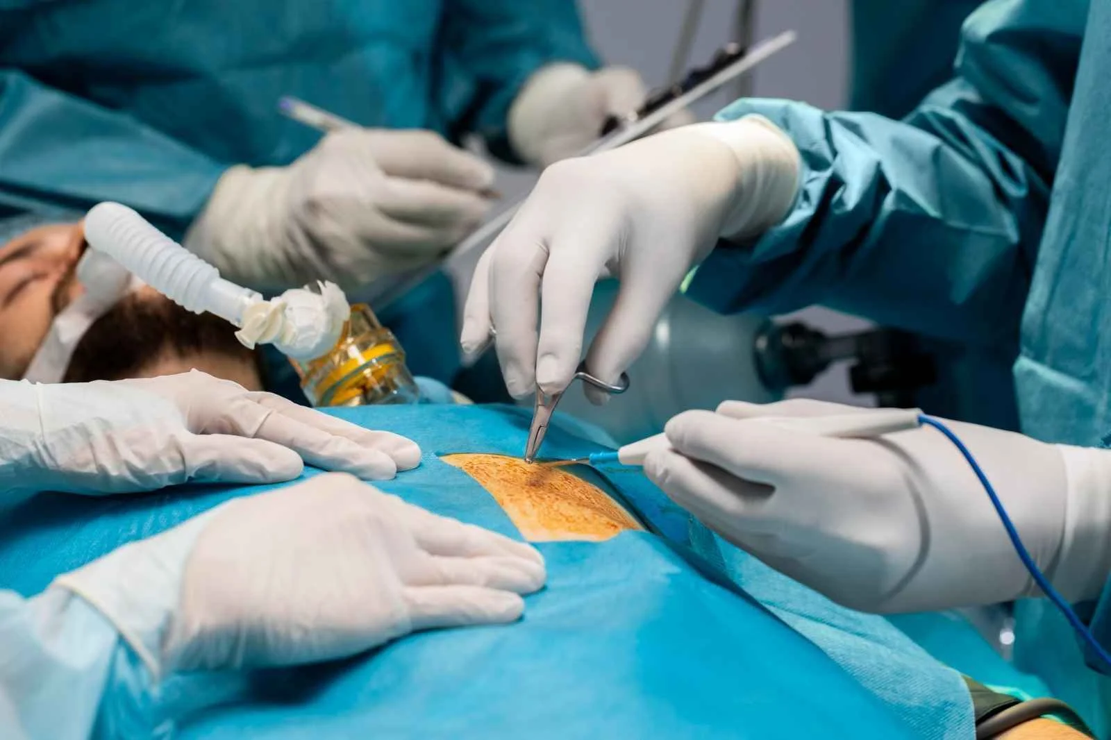 laproscopy-surgery