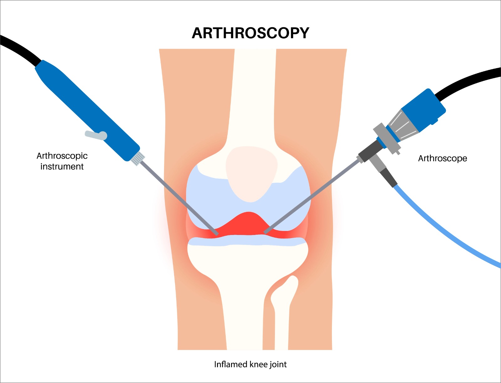 arthroscopy treatment